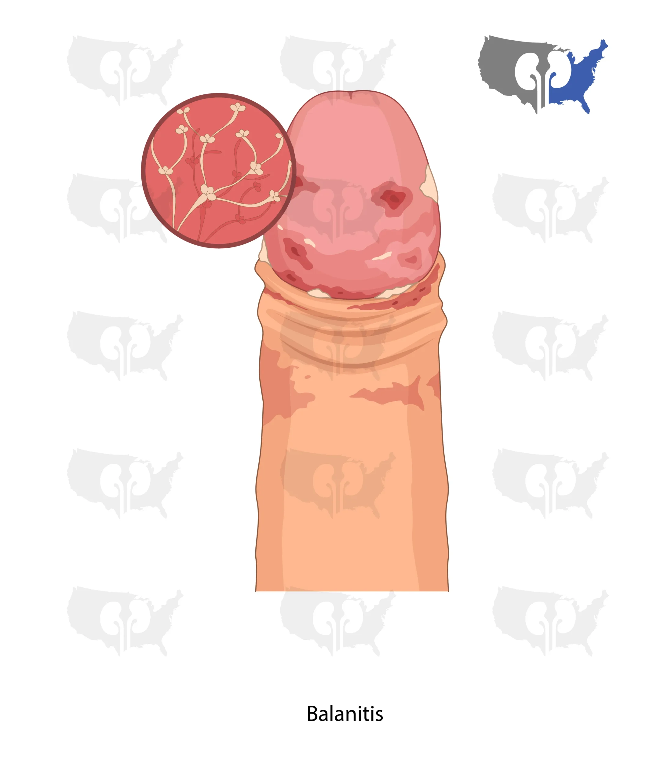 Balanitis